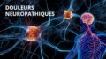 Douleurs neuropathiques