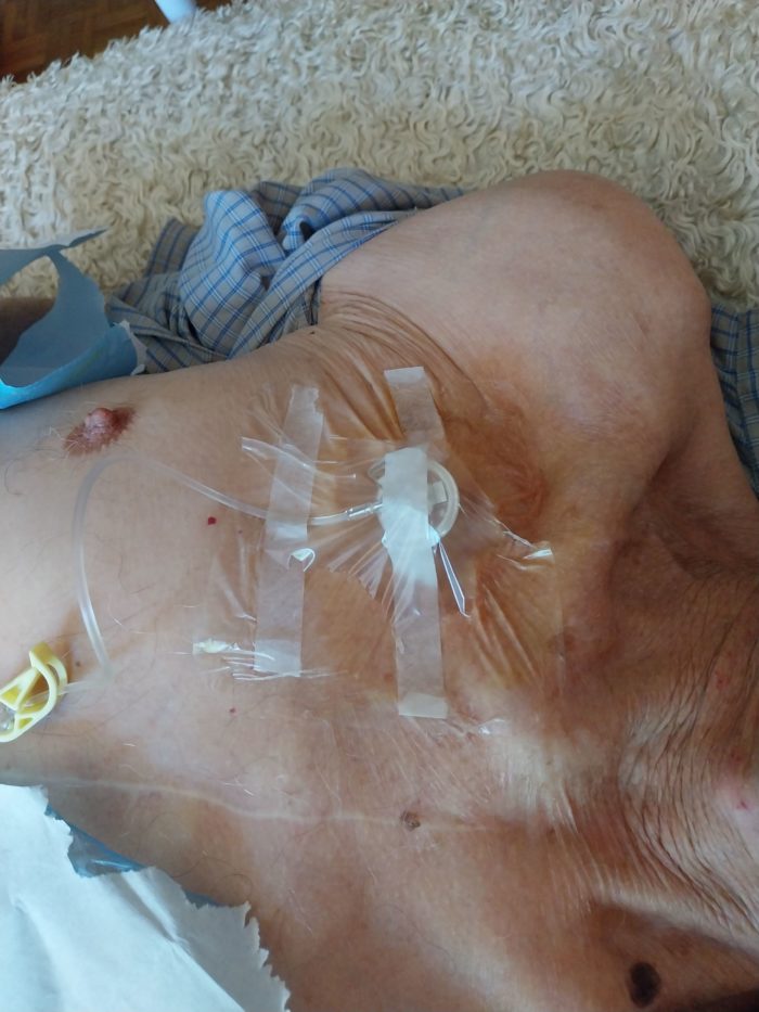 Chimiothérapie à domicile - perfusion posée
